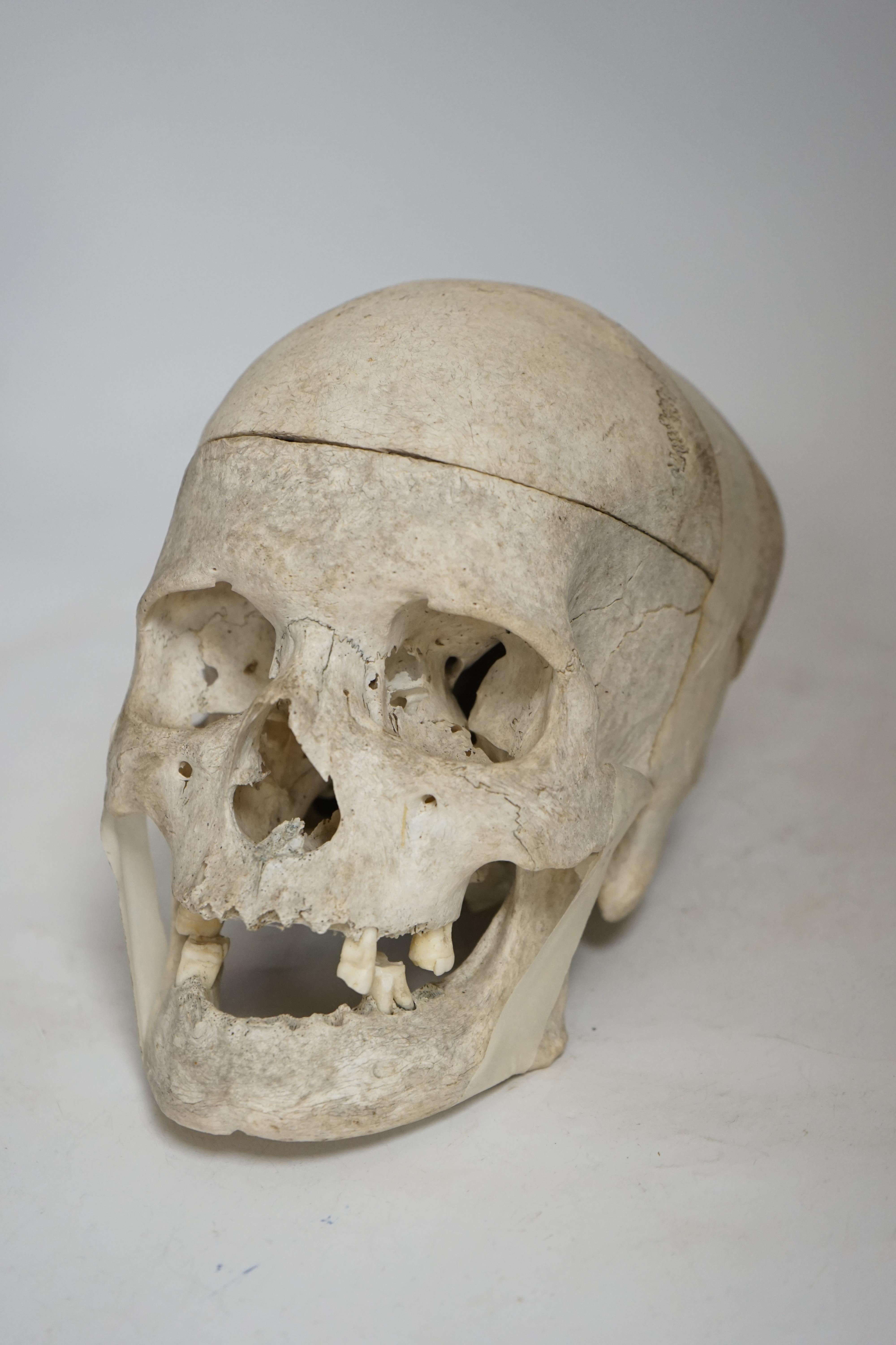 Human Anatomy - An Antique anatomical human skull, with lower jaw